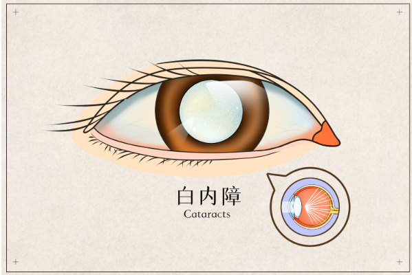 白內(nèi)障癥狀
